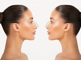 Rhinoplasty In Bhind