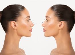 Rhinoplasty In Khandwa