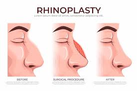 Rhinoplasty In Rewa
