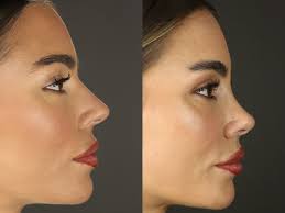 Rhinoplasty in Balrampur-Ramanujganj