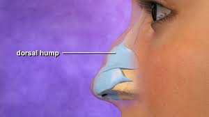 Rhinoplasty in Bilaspur