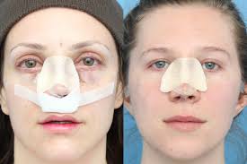 Rhinoplasty in Chhatarpur