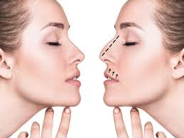 Rhinoplasty in Dhamtari