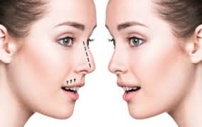 Rhinoplasty in Gariaband