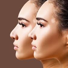 Rhinoplasty in Kanker