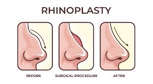Rhinoplasty in Khairagarh-Chhuikhadan-Gandai