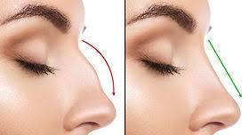Rhinoplasty in Kondagaon