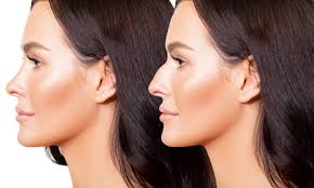 Rhinoplasty in Korba