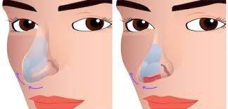 Rhinoplasty in Koriya
