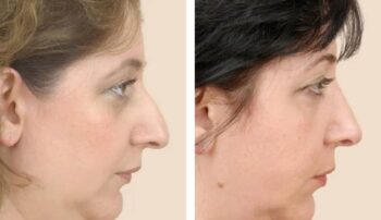Rhinoplasty in akola