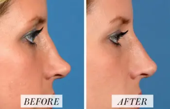 Rhinoplasty in amravati