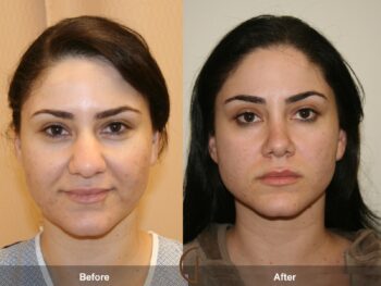 Rhinoplasty in gondia