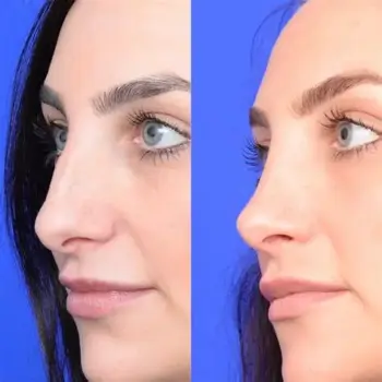 Rhinoplasty in yavatmal