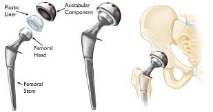 Robotic Assisted Surgery In Burhanpur