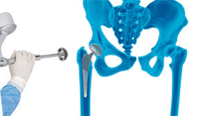 Robotic Assisted Surgery in Shivpuri