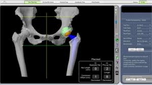 Robotic Hip Replacement In Chhindwara