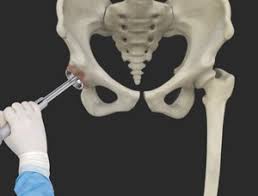 Robotic Hip Replacement In Seoni