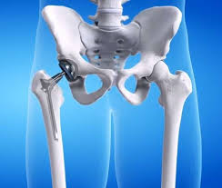 Robotic Hip Replacement In Singrauli