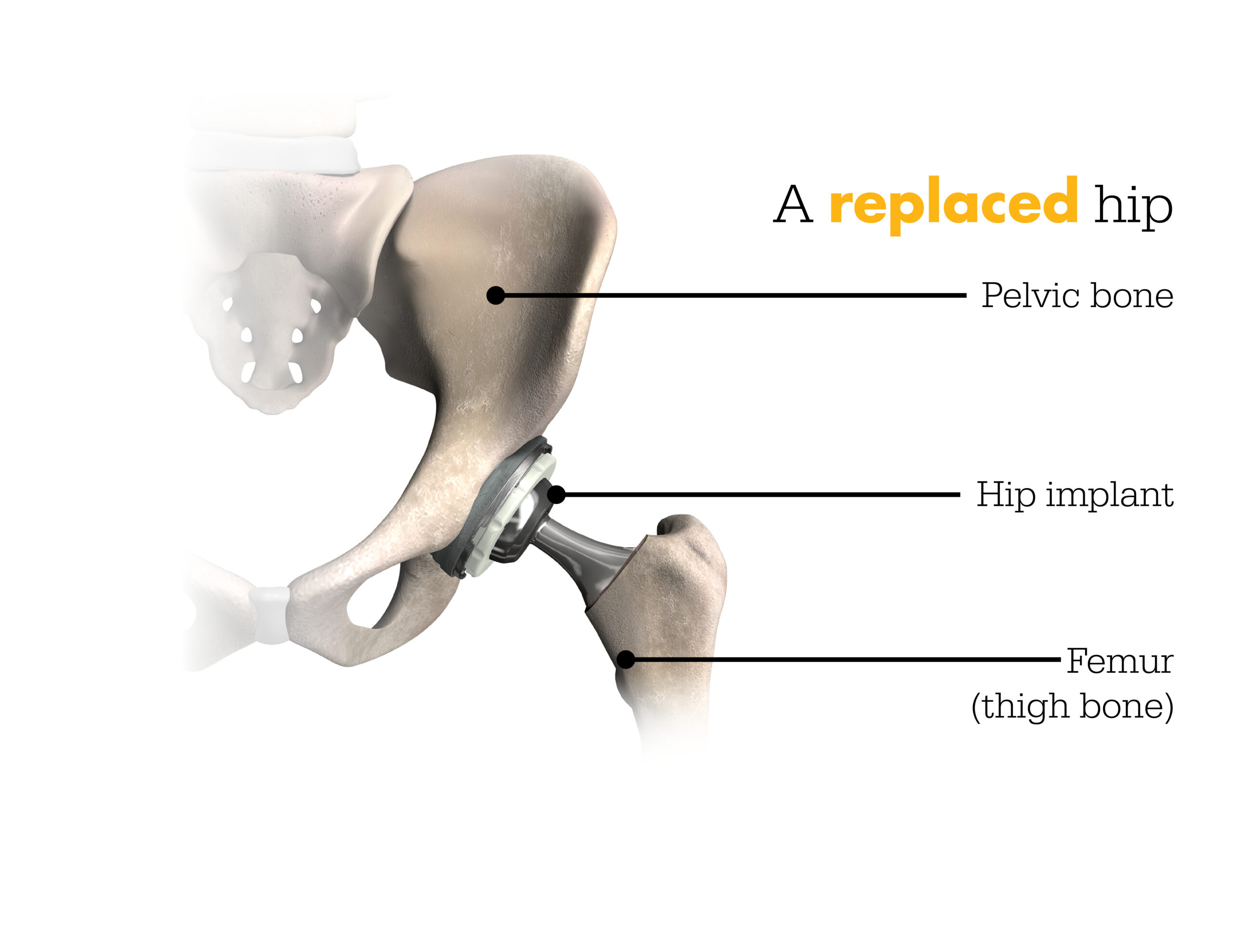 Robotic Hip Replacement in Bemetara
