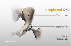 Hip Replacement Surgery in Dhamtari