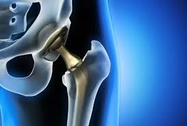 Robotic Hip Replacement in Durg