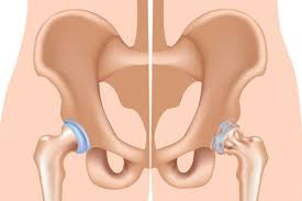 Robotic Hip Replacement in Kanker