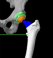 Robotic Hip Replacement in Kondagaon