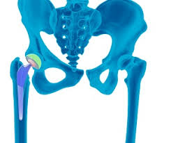Robotic Hip Replacement in Mahasamund