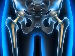 Robotic Hip Replacement in Mungeli
