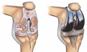 Robotic Joint Replacement in Balrampur-Ramanujganj