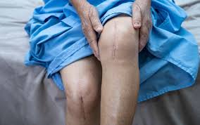 Robotic Knee Replacement In Morena