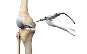 Robotic Knee Replacement In Sagar