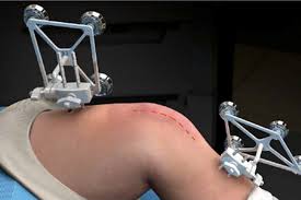 Robotic Knee Replacement in Dhamtari