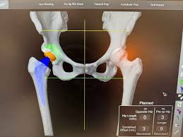 Robotic Orthopedic Surgery In Satna