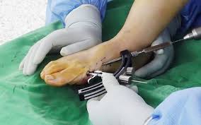 Robotic Orthopedic Surgery in Koriya