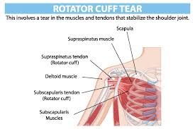 Rotator Cuff Surgeon In Raisen