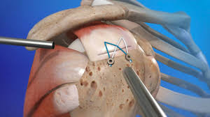 Rotator Cuff Surgeon In Seoni