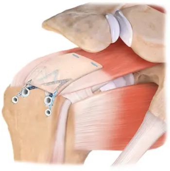Rotator cuff repair surgery
