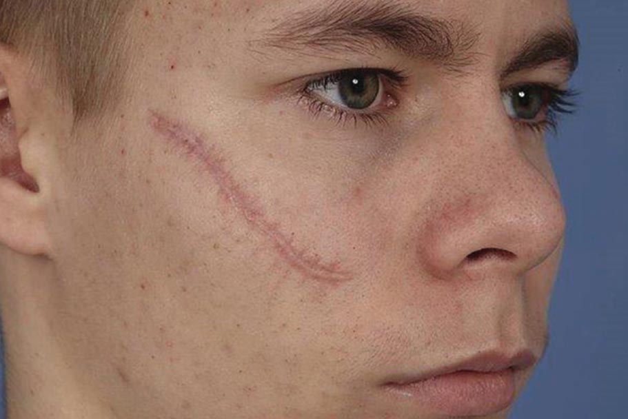 Scar revision surgery in Nagpur