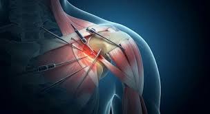 Shoulder Arthroscopy In Nagpur