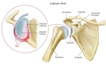 Shoulder labural tear repair