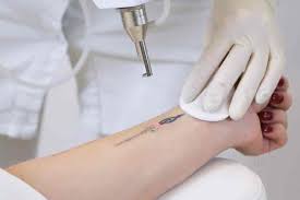 Tattoo Removal Treatment in Nagpur