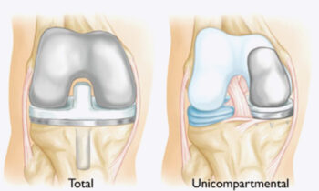 Unicompartmental knee surgery
