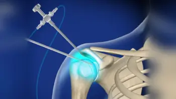 shoulder_ arthroscopy procedure