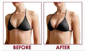 Breast Augmentation in Mungeli