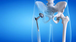 Hip Replacement Surgery In Neemach