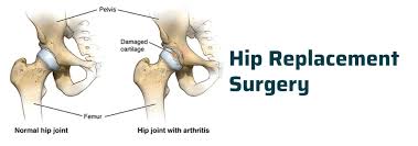 Hip Replacement Surgery in Narayanpur