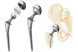 Hip Replacement Surgery in Rajnandgaon