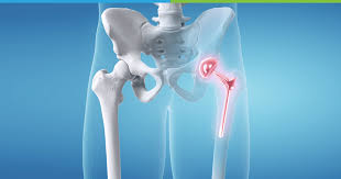 Hip Replacement Surgery in Sakti
