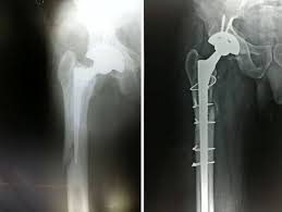 Hip Replacement Surgery in Sukma